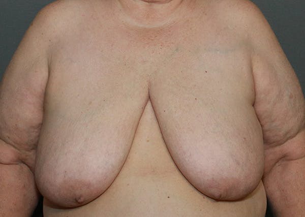 Breast Reconstruction Before & After Gallery - Patient 142468192 - Image 1
