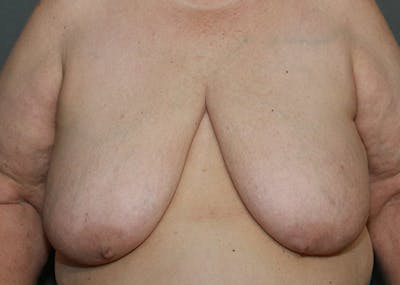 Breast Reconstruction Before & After Gallery - Patient 142468193 - Image 1