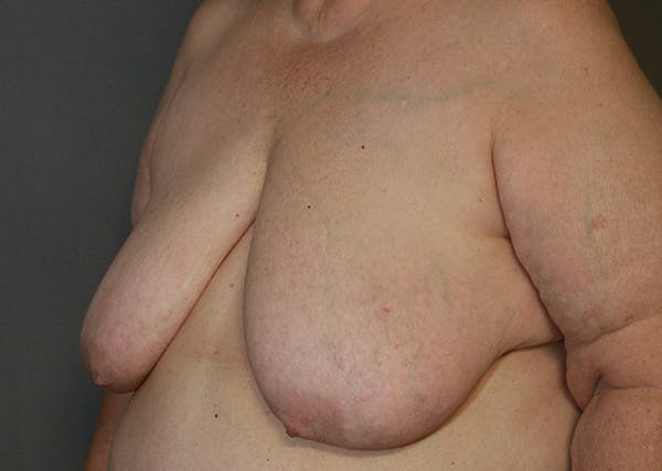 Breast Reconstruction Before & After Gallery - Patient 142468192 - Image 5