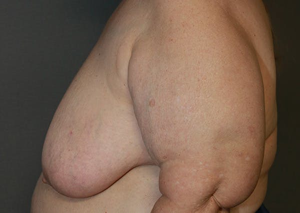 Breast Reconstruction Before & After Gallery - Patient 142468192 - Image 7