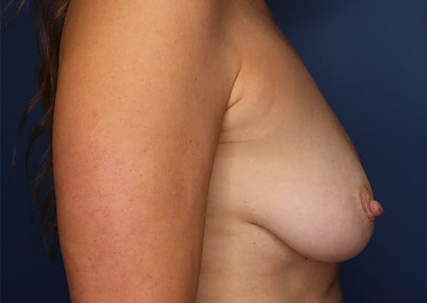 Breast Reconstruction Before & After Gallery - Patient 142468194 - Image 5