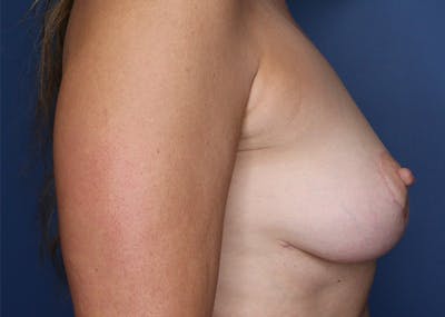 Breast Reconstruction Before & After Gallery - Patient 142468194 - Image 6
