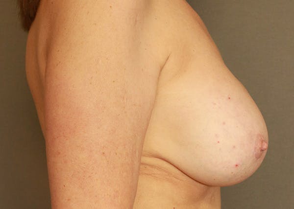 Breast Reconstruction Before & After Gallery - Patient 142468195 - Image 5