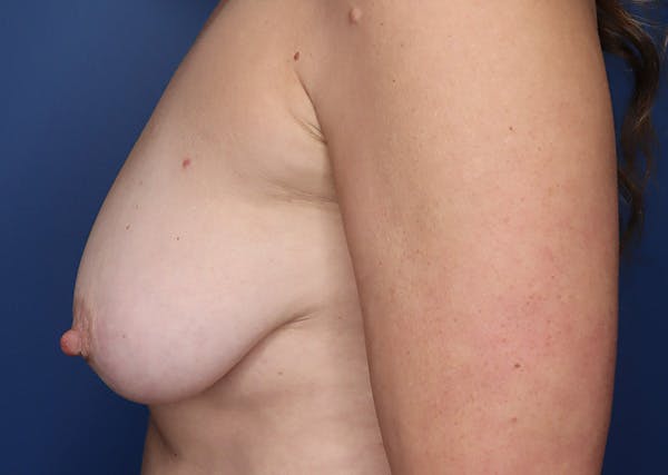 Breast Reconstruction Before & After Gallery - Patient 142468194 - Image 9