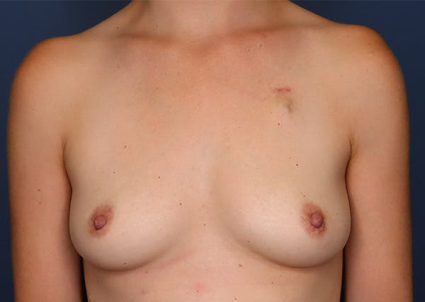 Breast Reconstruction Before & After Gallery - Patient 142468197 - Image 1