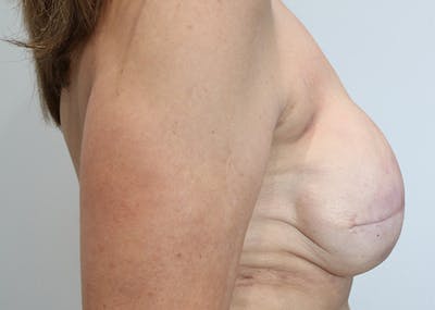 Breast Reconstruction Before & After Gallery - Patient 142468195 - Image 6