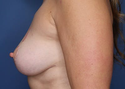 Breast Reconstruction Before & After Gallery - Patient 142468194 - Image 10