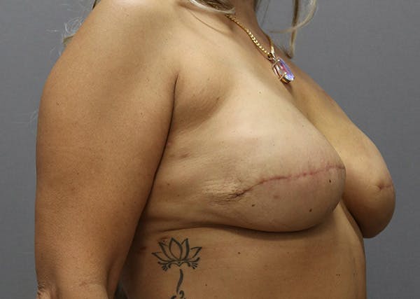 Breast Reconstruction Before & After Gallery - Patient 142468196 - Image 4