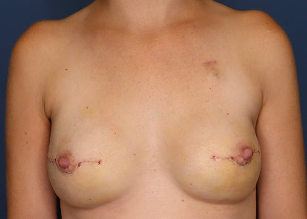 Breast Reconstruction Before & After Gallery - Patient 142468197 - Image 2