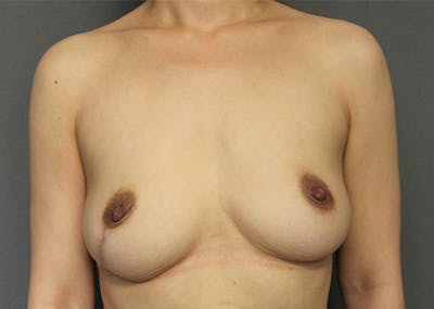 Breast Reconstruction Before & After Gallery - Patient 142468198 - Image 1