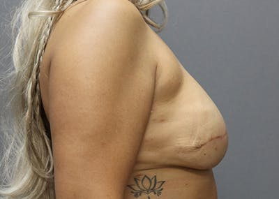 Breast Reconstruction Before & After Gallery - Patient 142468196 - Image 6