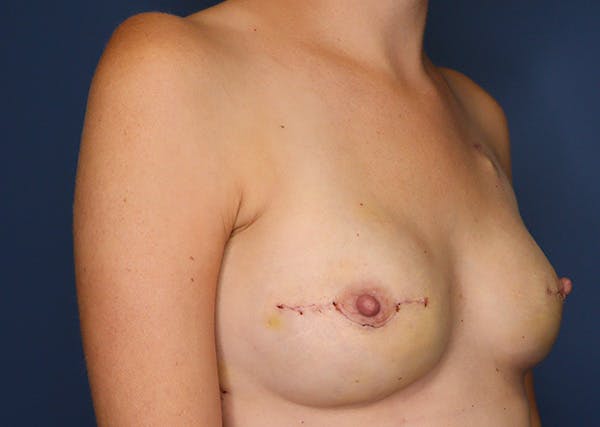 Breast Reconstruction Before & After Gallery - Patient 142468197 - Image 4