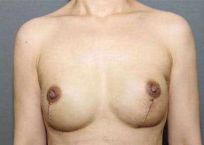 Breast Reconstruction Before & After Gallery - Patient 142468198 - Image 2