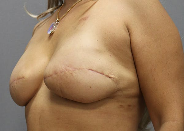 Breast Reconstruction Before & After Gallery - Patient 142468196 - Image 8