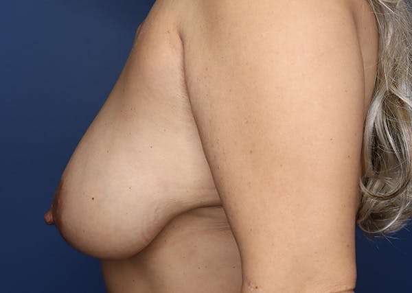 Breast Reconstruction Before & After Gallery - Patient 142468196 - Image 9