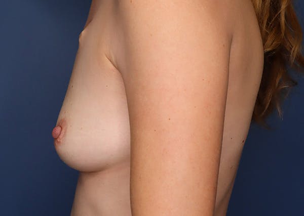 Breast Reconstruction Before & After Gallery - Patient 142468197 - Image 7