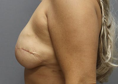 Breast Reconstruction Before & After Gallery - Patient 142468196 - Image 10