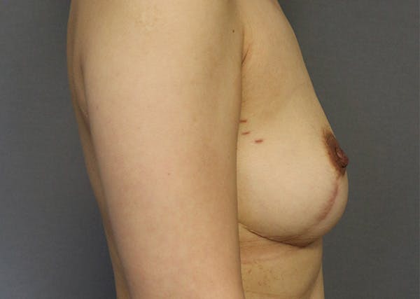 Breast Reconstruction Before & After Gallery - Patient 142468198 - Image 5