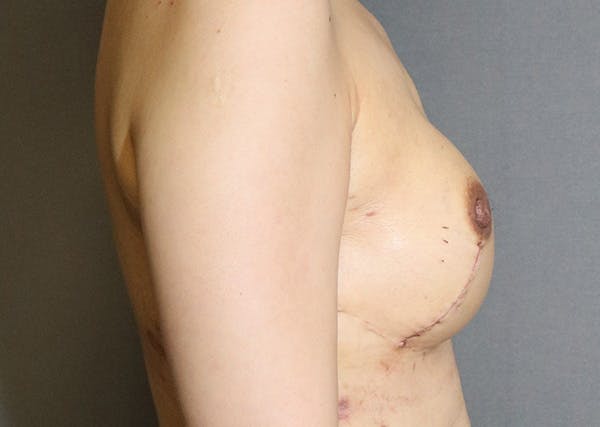 Breast Reconstruction Before & After Gallery - Patient 142468198 - Image 6