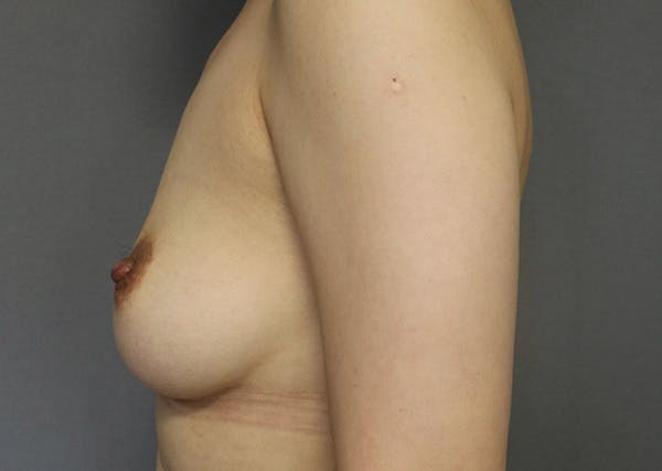 Breast Reconstruction Before & After Gallery - Patient 142468198 - Image 9