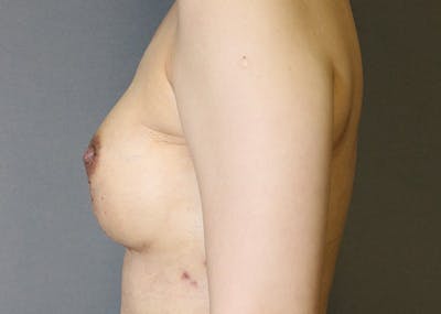 Breast Reconstruction Before & After Gallery - Patient 142468198 - Image 10