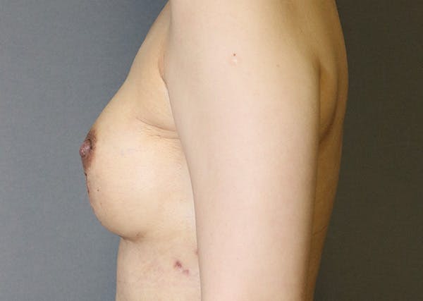 Breast Reconstruction Before & After Gallery - Patient 142468198 - Image 10