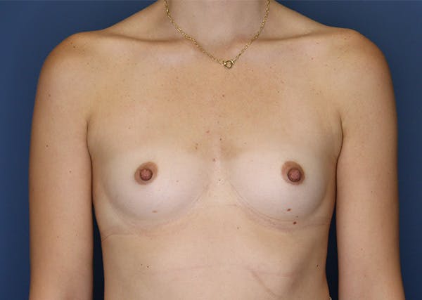 Breast Augmentation Before & After Gallery - Patient 144486402 - Image 1