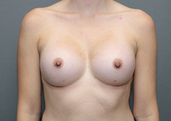 Breast Augmentation Before & After Gallery - Patient 144486402 - Image 2