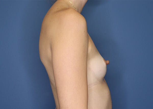Breast Augmentation Before & After Gallery - Patient 144486402 - Image 5