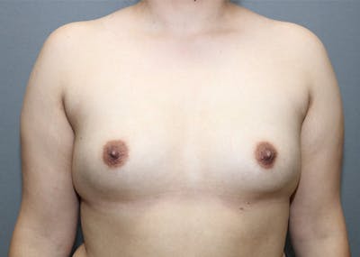 Breast Augmentation Before & After Gallery - Patient 144486432 - Image 1