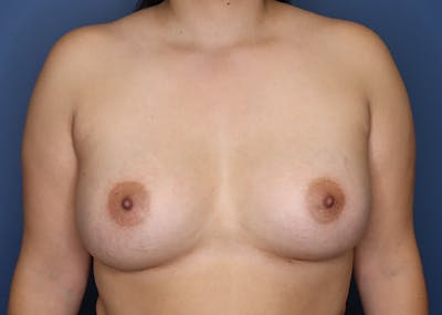 Breast Augmentation Before & After Gallery - Patient 144486432 - Image 2