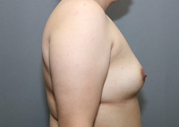 Breast Augmentation Before & After Gallery - Patient 144486432 - Image 5