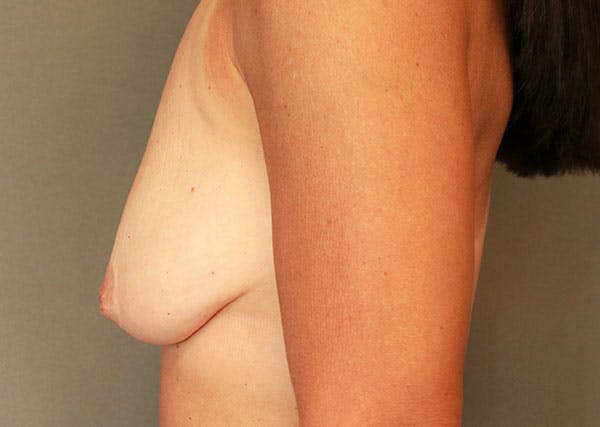 Breast Reconstruction Before & After Gallery - Patient 148588126 - Image 5
