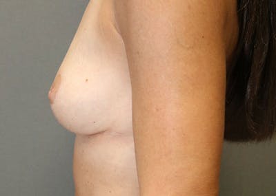 Breast Reconstruction Before & After Gallery - Patient 148588126 - Image 6