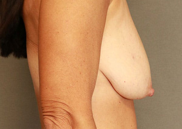 Breast Reconstruction Before & After Gallery - Patient 148588126 - Image 9