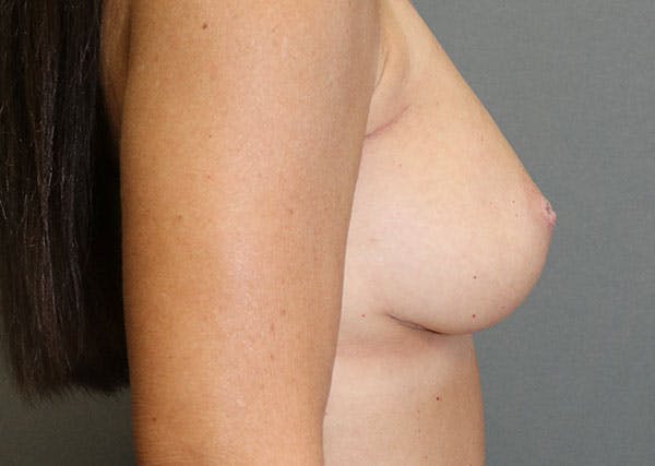 Breast Reconstruction Before & After Gallery - Patient 148588126 - Image 10