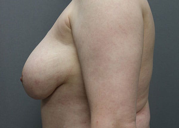 Breast Reconstruction Before & After Gallery - Patient 148588127 - Image 5