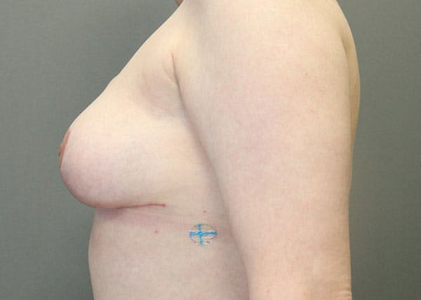 Breast Reconstruction Before & After Gallery - Patient 148588127 - Image 6