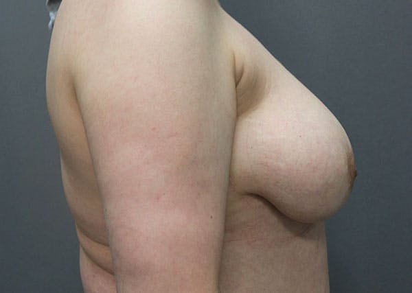 Breast Reconstruction Before & After Gallery - Patient 148588127 - Image 9