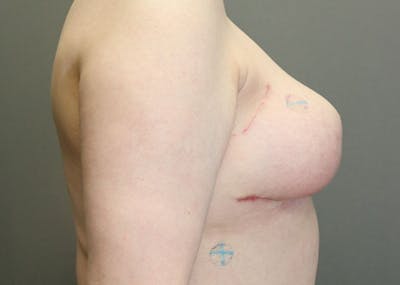 Breast Reconstruction Before & After Gallery - Patient 148588127 - Image 10
