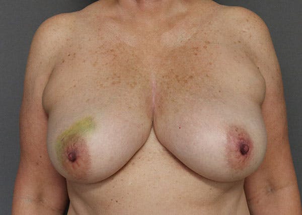 Breast Reconstruction Before & After Gallery - Patient 148588125 - Image 1