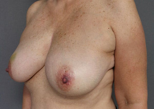 Breast Reconstruction Before & After Gallery - Patient 148588125 - Image 3