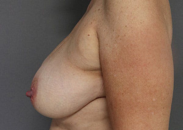 Breast Reconstruction Before & After Gallery - Patient 148588125 - Image 5