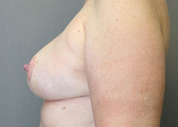 Breast Reconstruction Before & After Gallery - Patient 148588125 - Image 6