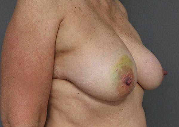 Breast Reconstruction Before & After Gallery - Patient 148588125 - Image 7