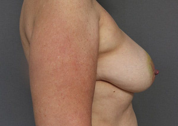 Breast Reconstruction Before & After Gallery - Patient 148588125 - Image 9