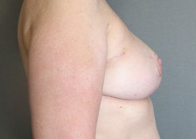 Breast Reconstruction Before & After Gallery - Patient 148588125 - Image 10