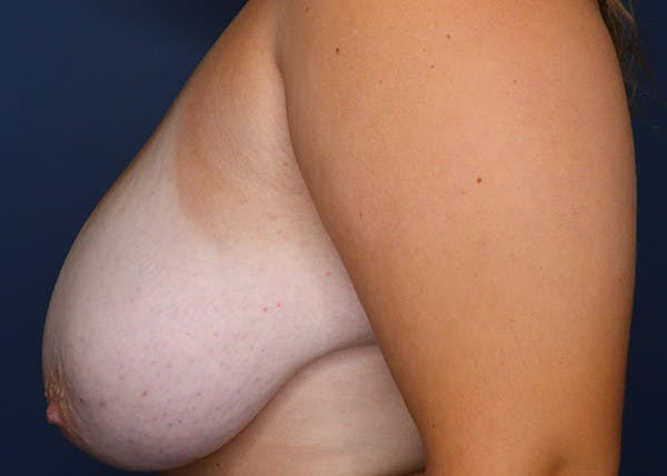 Breast Reduction Before & After Gallery - Patient 148648436 - Image 5