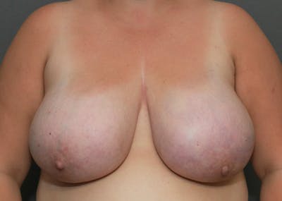 Breast Reduction Before & After Gallery - Patient 148648435 - Image 1