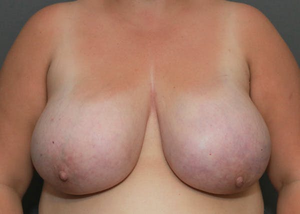 Breast Reduction Before & After Gallery - Patient 148648435 - Image 1